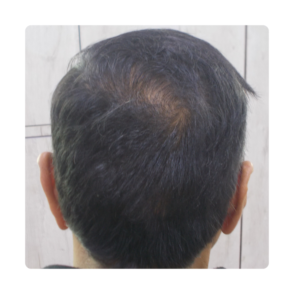 Hair Growth Treatment After