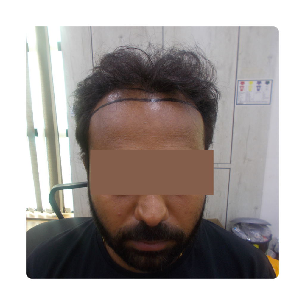 Hair Transplant At Front of Head Before