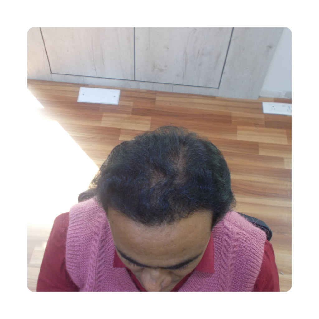 Hair Transplant At Top of Head After