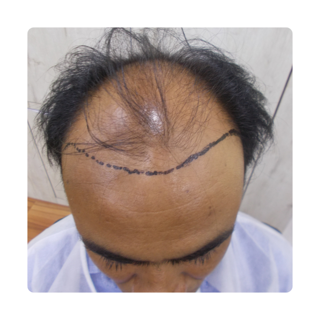 Hair Transplant At Top of Head Before