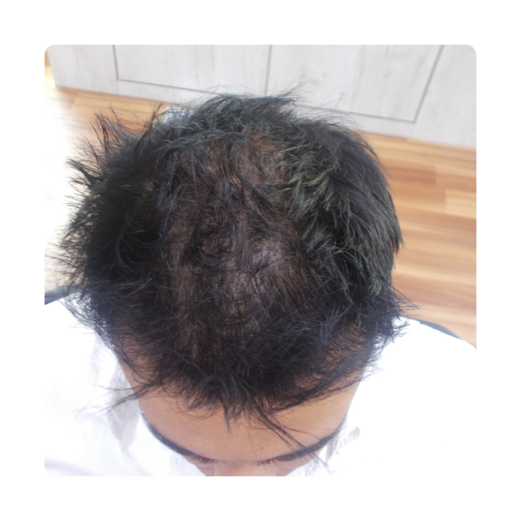 Top Of Head Hair Growth Treatment After