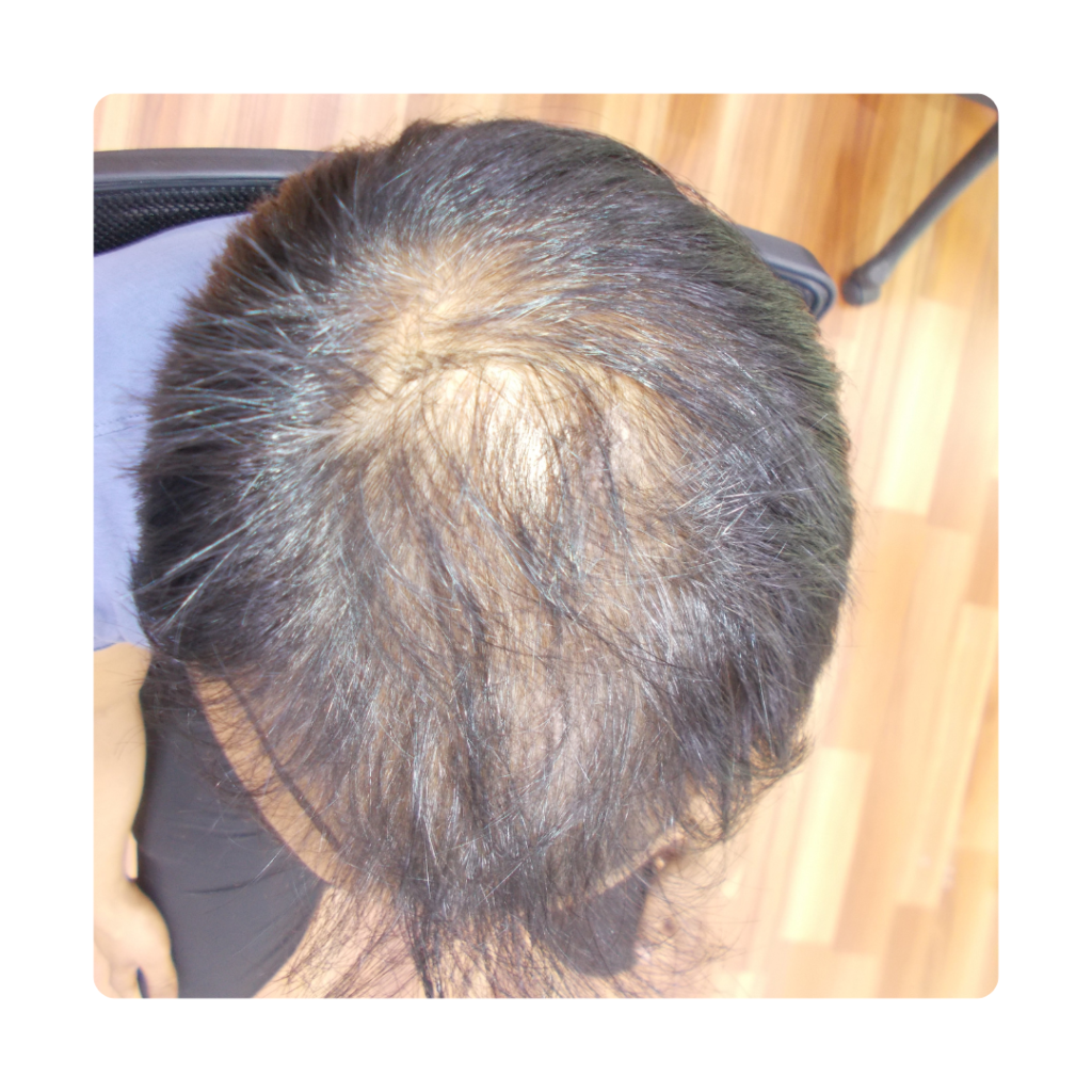 Top Of Head Hair Growth Treatment Before