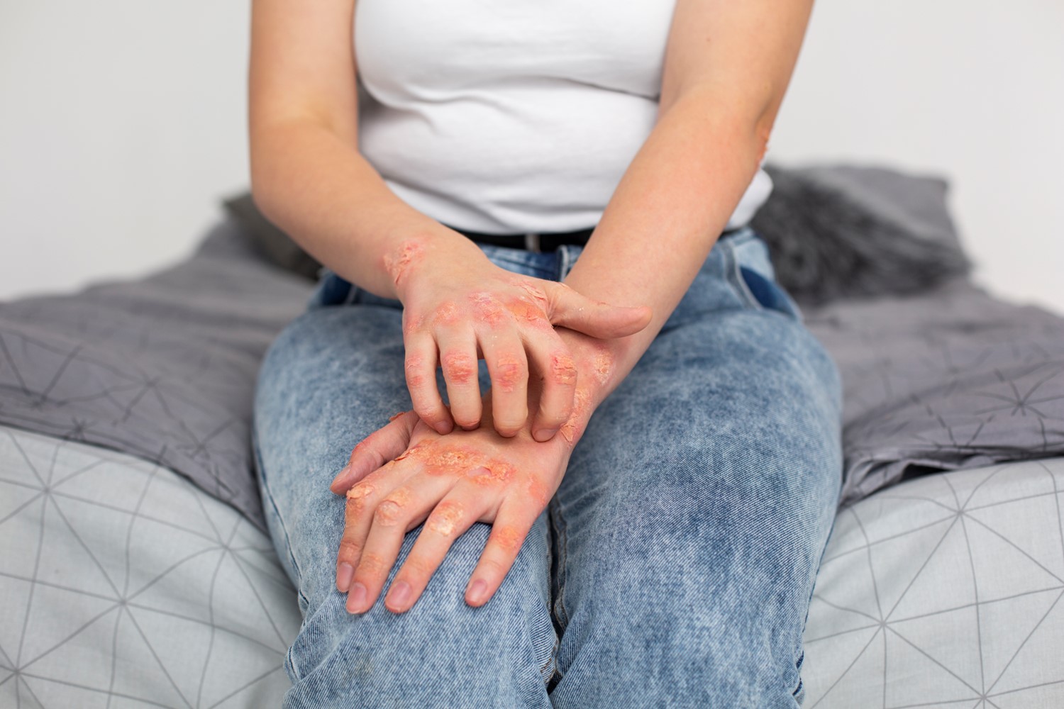Living with Psoriasis: Coping Strategies and Support Resources 