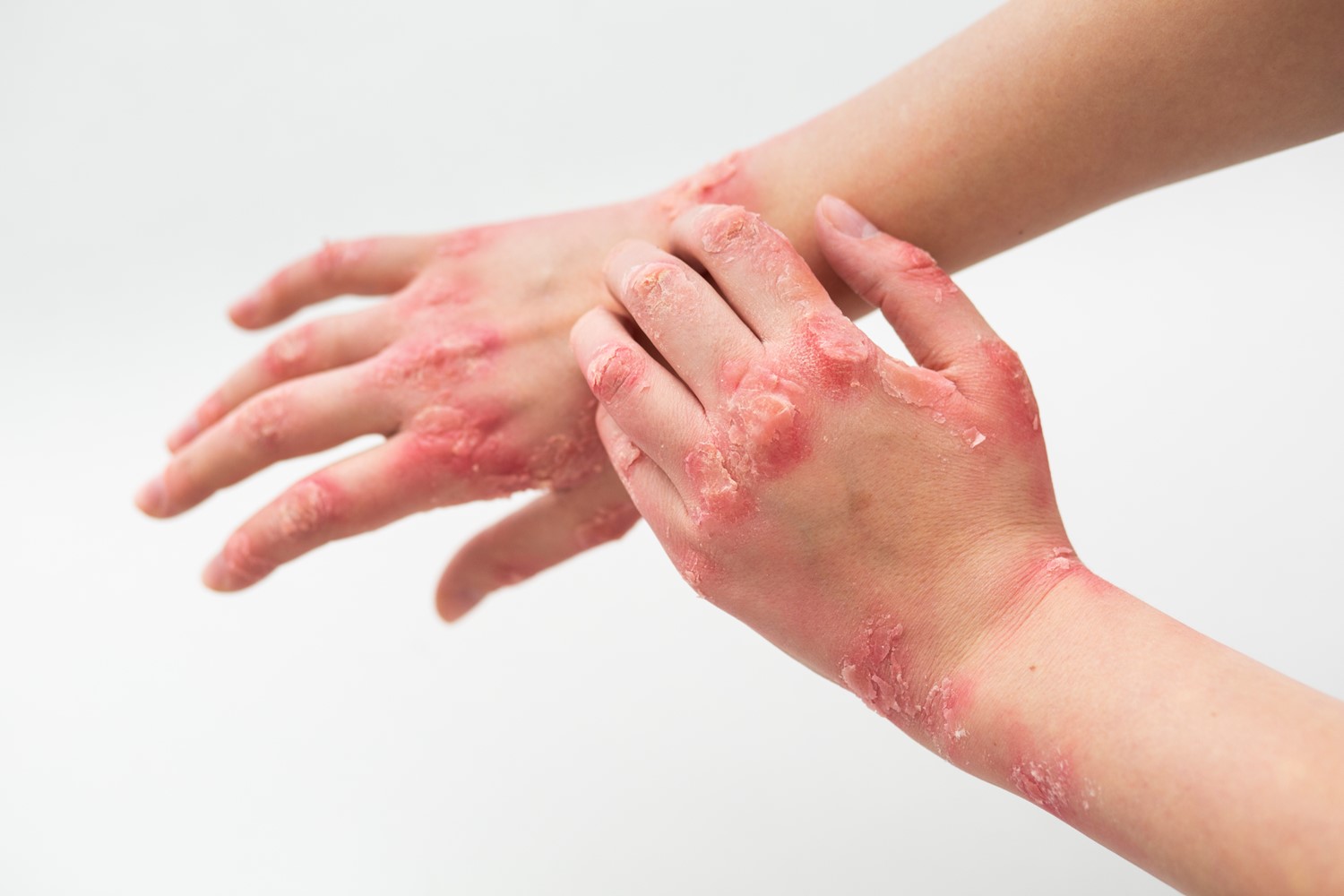 Everything You Should Know About Psoriasis  